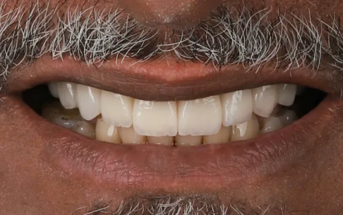 Depois: Luis Claudio, sorriso