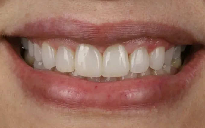 Depois: Marcia Ximenes, sorriso