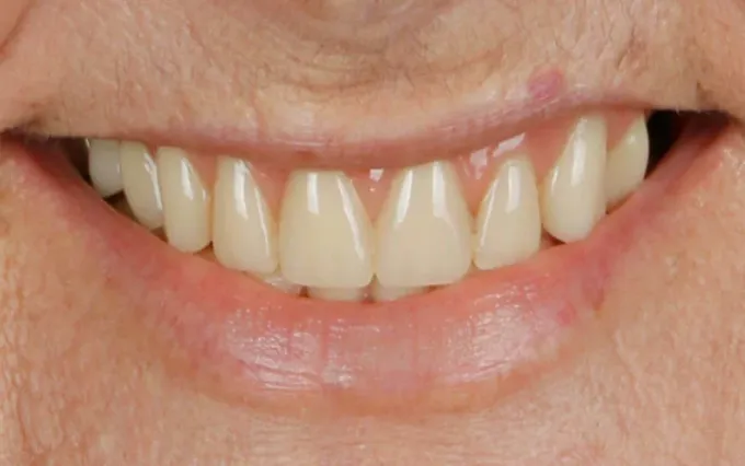 Antes: Maria Targino, sorriso