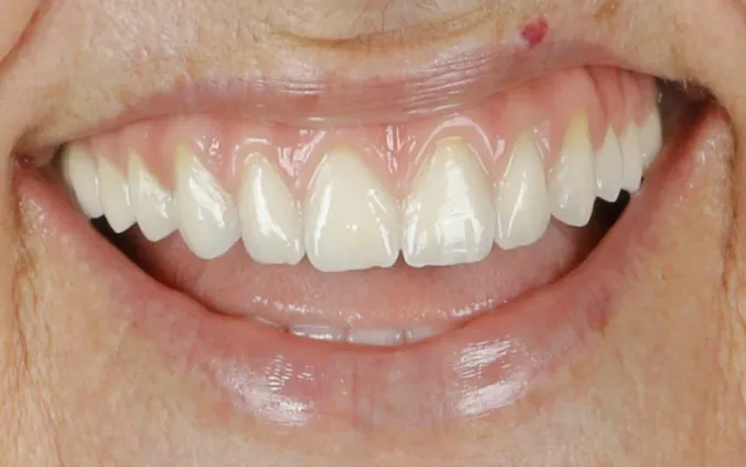Depois: Maria Targino, sorriso
