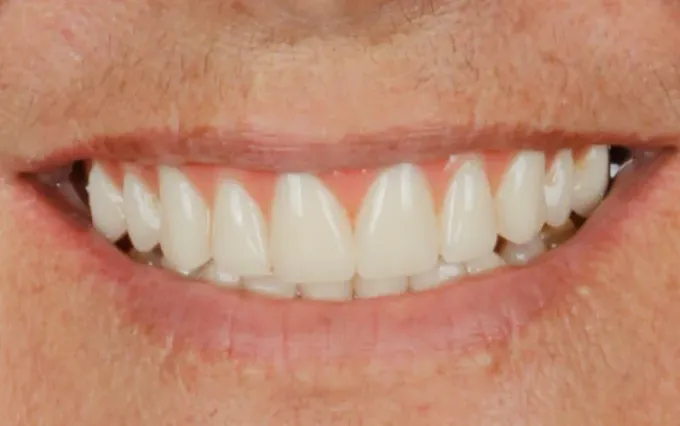 Antes: Suzana Targino, sorriso